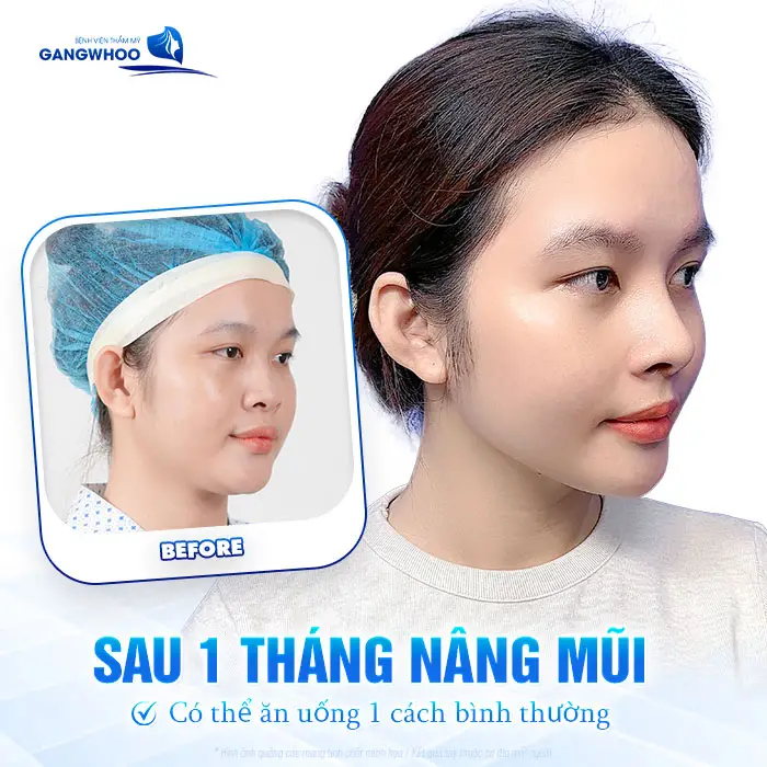 Nâng Mũi Ăn Yến Mạch Được Không? Bác Sĩ Trần Kim Thạch Giải Đáp