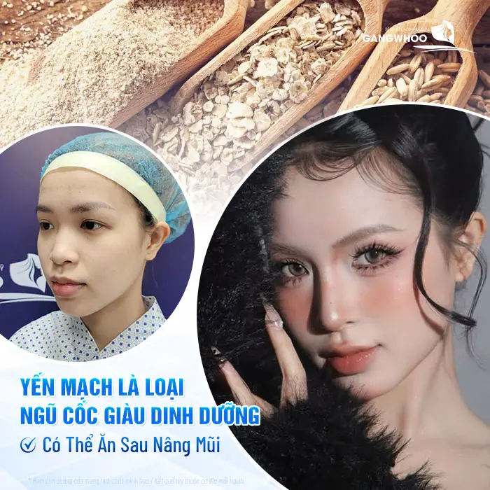 Nâng Mũi Ăn Yến Mạch Được Không? Bác Sĩ Trần Kim Thạch Giải Đáp