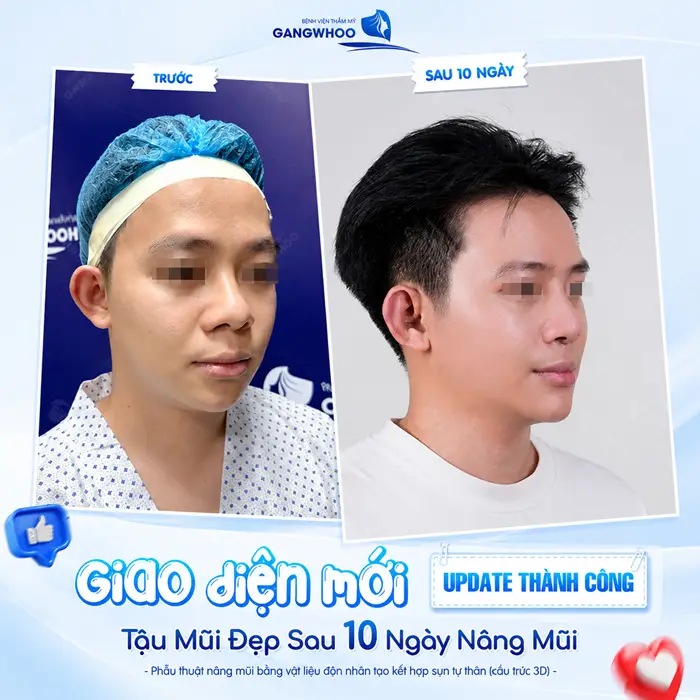 Nâng Mũi Bao Lâu Thì Đầu Mũi Hết To? Bác Sĩ Giải Đáp Chi Tiết