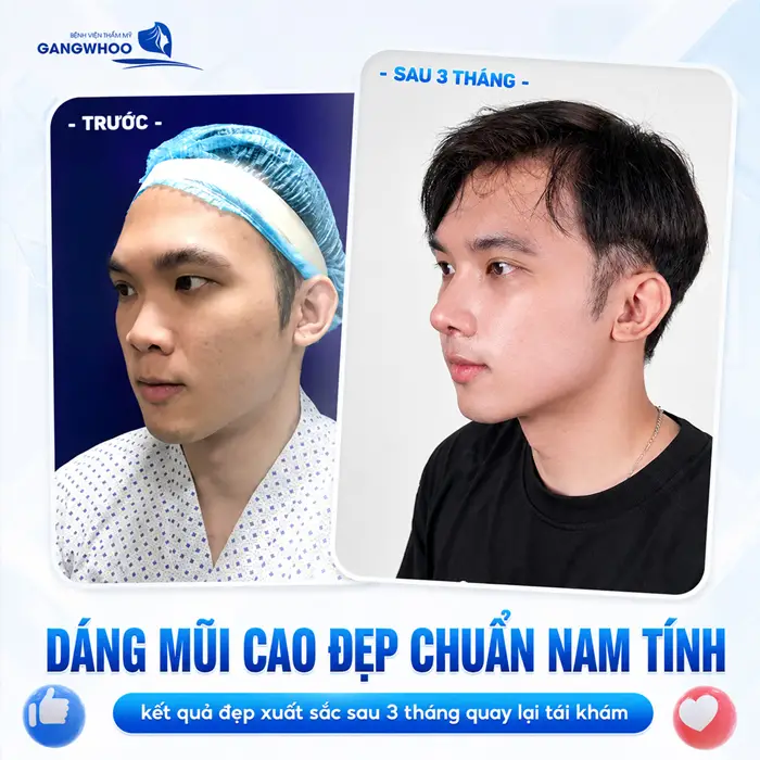 Nâng Mũi Bao Lâu Thì Đầu Mũi Hết To? Bác Sĩ Giải Đáp Chi Tiết