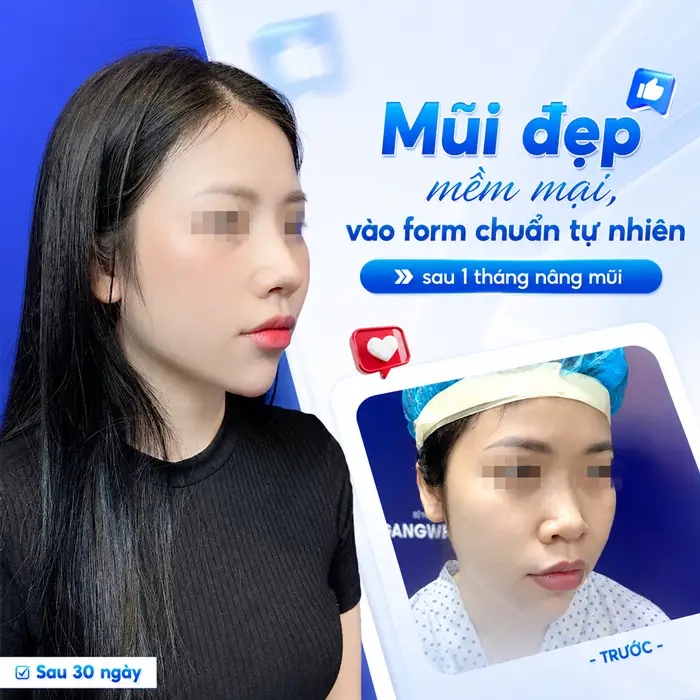 Nâng Mũi Bao Lâu Thì Đầu Mũi Hết To? Bác Sĩ Giải Đáp Chi Tiết