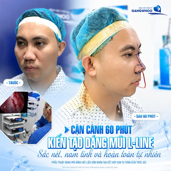 Nâng Mũi Bao Lâu Thì Đầu Mũi Hết To? Bác Sĩ Giải Đáp Chi Tiết