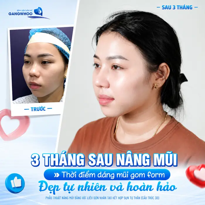 Nâng Mũi Sau Bao Lâu Thì Gom Lại? Giải Đáp Chi Tiết Từng Giai Đoạn