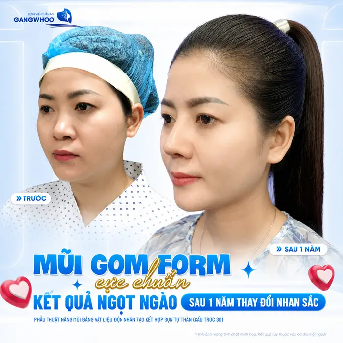 Nâng Mũi Sau Bao Lâu Thì Gom Lại? Giải Đáp Chi Tiết Từng Giai Đoạn
