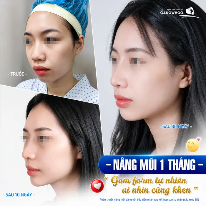 Nâng Mũi Sau Bao Lâu Thì Gom Lại? Giải Đáp Chi Tiết Từng Giai Đoạn