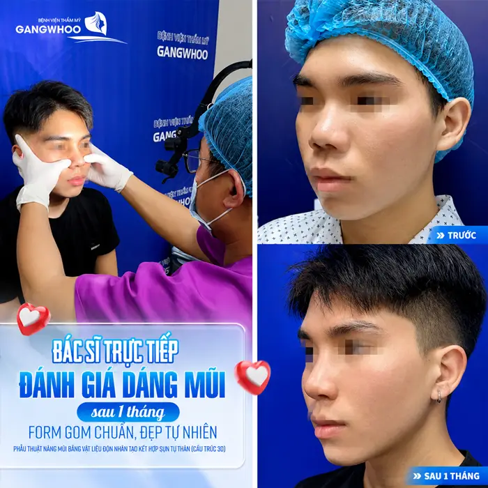 Nâng Mũi Sau Bao Lâu Thì Gom Lại? Giải Đáp Chi Tiết Từng Giai Đoạn