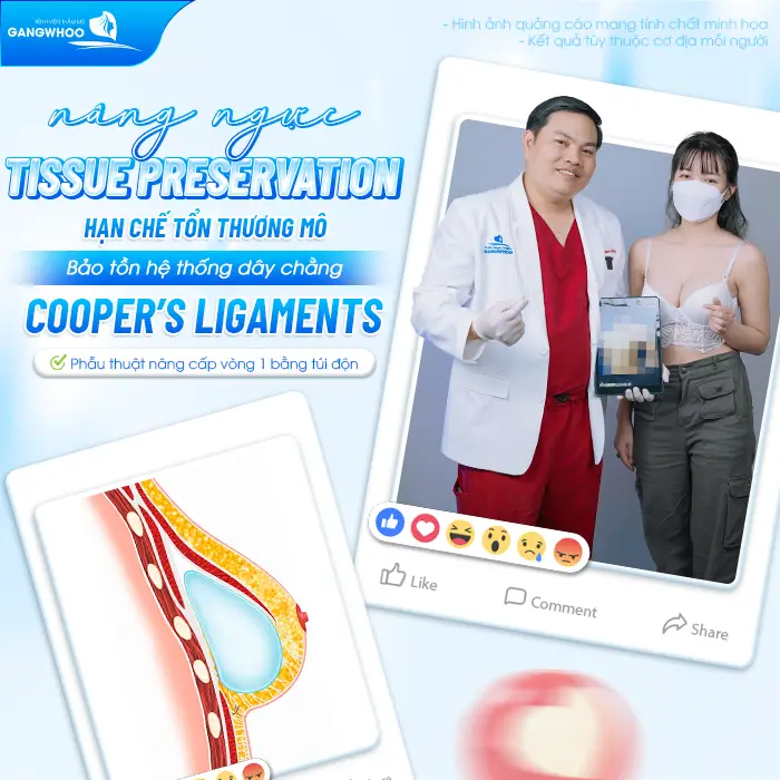 Nâng Ngực Tissue Preservation Là Gì? Tại Sao Là Công Nghệ Bảo Tồn Mô Vú Thế Hệ Mới