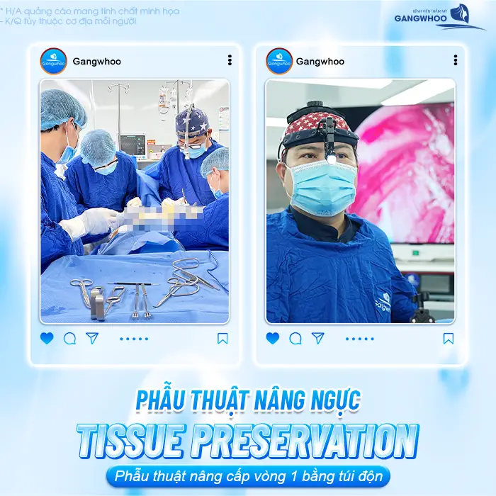 Nâng Ngực Tissue Preservation Là Gì? Tại Sao Là Công Nghệ Bảo Tồn Mô Vú Thế Hệ Mới