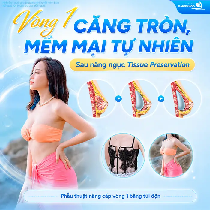 Nâng Ngực Tissue Preservation Là Gì? Tại Sao Là Công Nghệ Bảo Tồn Mô Vú Thế Hệ Mới