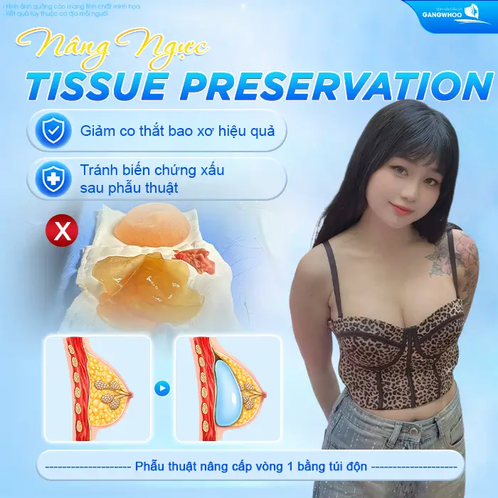 Nâng Ngực Tissue Preservation Là Gì? Tại Sao Là Công Nghệ Bảo Tồn Mô Vú Thế Hệ Mới