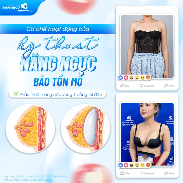 Nâng Ngực Tissue Preservation Là Gì? Tại Sao Là Công Nghệ Bảo Tồn Mô Vú Thế Hệ Mới