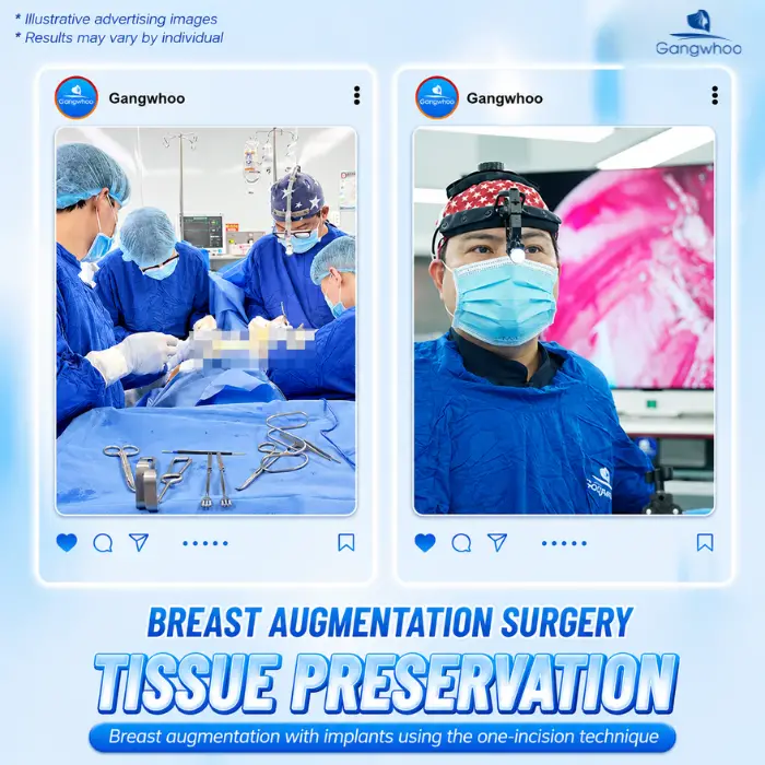 breast augmentation with tissue preservation 12