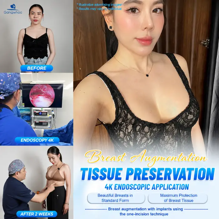 breast augmentation with tissue preservation 15