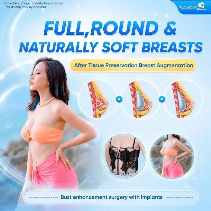 Naturally full, soft, and well-shaped breasts after Tissue Preservation Breast Augmentation