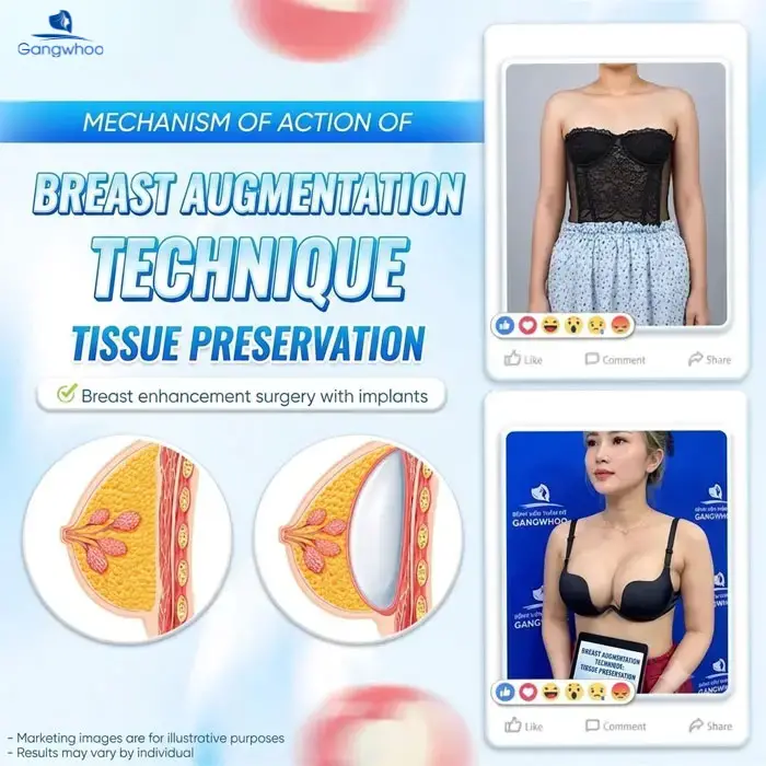 breast augmentation with tissue preservation 3 1