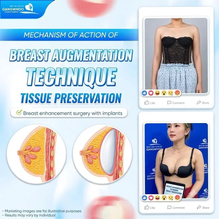 Mechanism of the Tissue Preservation Breast Augmentation technique