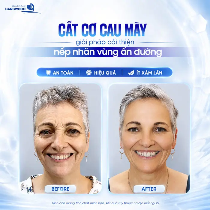 Cắt Cơ Cau Mày Giá Bao Nhiêu? Bảng Giá Xóa Cau Mày 2026 7 Cắt Cơ Cau Mày Giá Bao Nhiêu? Bảng Giá Xóa Cau Mày 2026