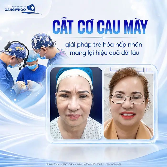 Cắt Cơ Cau Mày Giá Bao Nhiêu? Bảng Giá Xóa Cau Mày 2026 2 Cắt Cơ Cau Mày Giá Bao Nhiêu? Bảng Giá Xóa Cau Mày 2026
