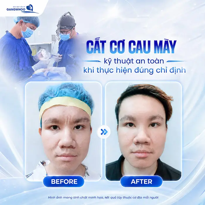Cắt Cơ Cau Mày Giá Bao Nhiêu? Bảng Giá Xóa Cau Mày 2026 3 Cắt Cơ Cau Mày Giá Bao Nhiêu? Bảng Giá Xóa Cau Mày 2026