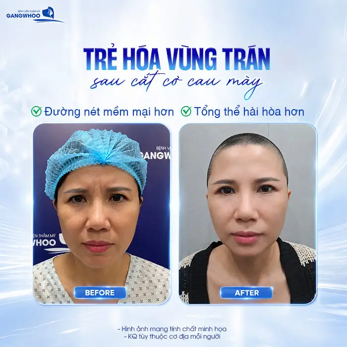 Cắt Cơ Cau Mày Giá Bao Nhiêu? Bảng Giá Xóa Cau Mày 2026 6 Cắt Cơ Cau Mày Giá Bao Nhiêu? Bảng Giá Xóa Cau Mày 2026