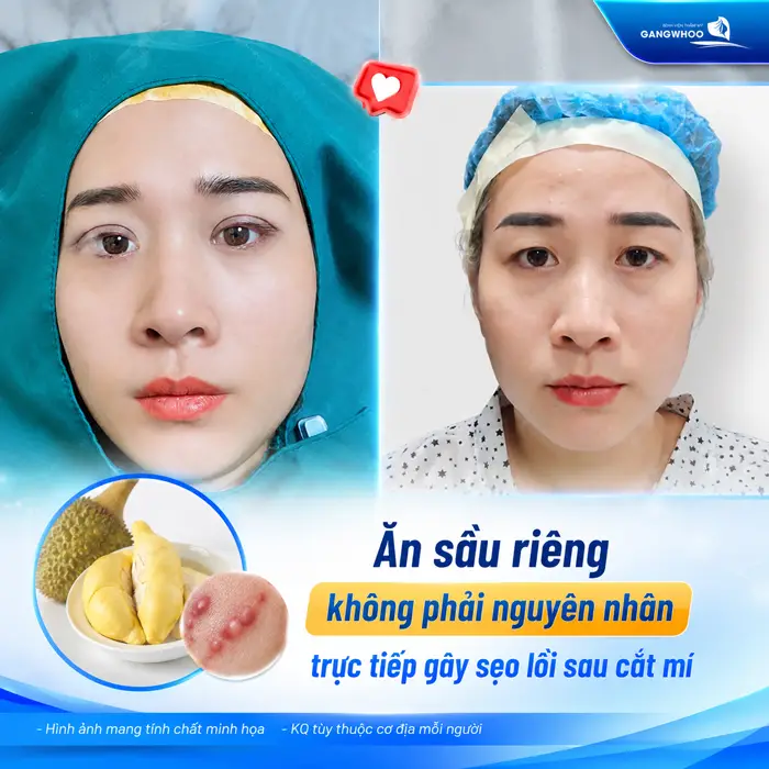 Cắt Mí Mắt Ăn Sầu Riêng Được Không? Bác Sĩ Giải Đáp Chi Tiết