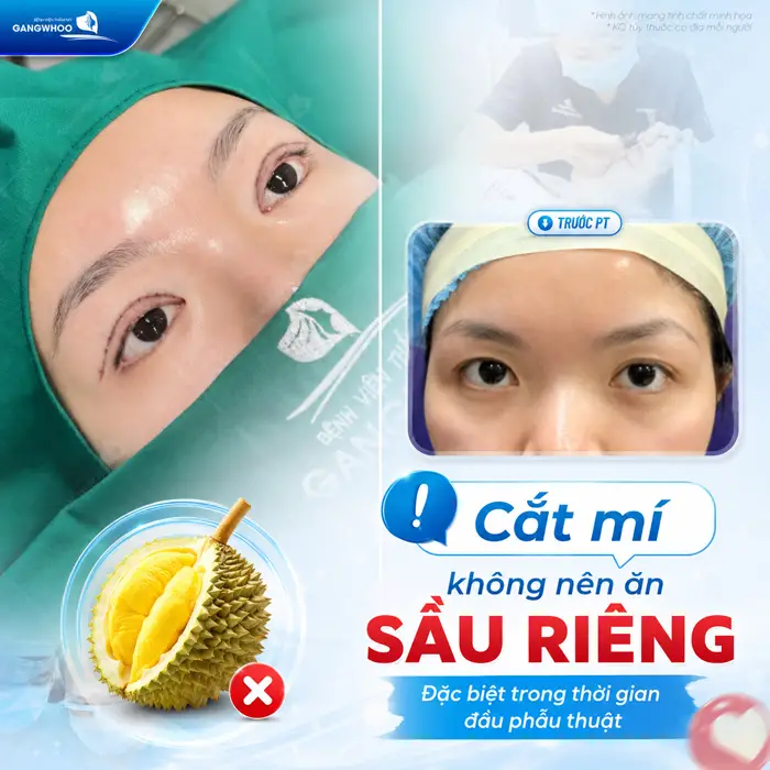Cắt Mí Mắt Ăn Sầu Riêng Được Không? Bác Sĩ Giải Đáp Chi Tiết