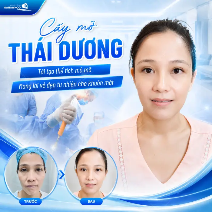 Cấy Mỡ Thái Dương Là Gì? Quy Trình, Hiệu Quả, Chi Phí 4 Cấy Mỡ Thái Dương Là Gì? Quy Trình, Hiệu Quả, Chi Phí