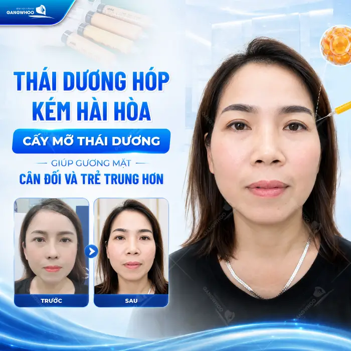 Cấy Mỡ Thái Dương Là Gì? Quy Trình, Hiệu Quả, Chi Phí 9 Cấy Mỡ Thái Dương Là Gì? Quy Trình, Hiệu Quả, Chi Phí