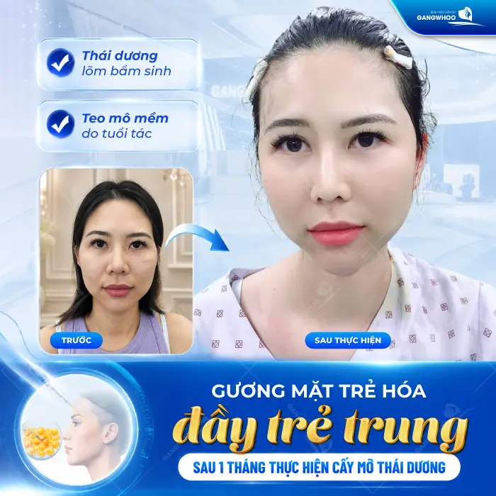 Cấy Mỡ Thái Dương Là Gì? Quy Trình, Hiệu Quả, Chi Phí 2 Cấy Mỡ Thái Dương Là Gì? Quy Trình, Hiệu Quả, Chi Phí