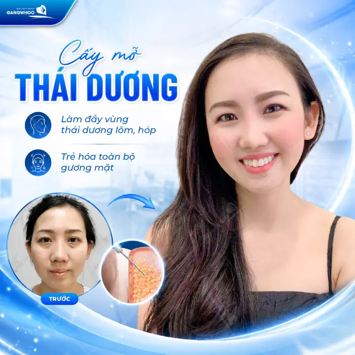 Cấy Mỡ Thái Dương Là Gì? Quy Trình, Hiệu Quả, Chi Phí 3 Cấy Mỡ Thái Dương Là Gì? Quy Trình, Hiệu Quả, Chi Phí