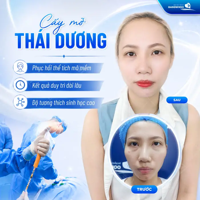 Cấy Mỡ Thái Dương Là Gì? Quy Trình, Hiệu Quả, Chi Phí 1 Cấy Mỡ Thái Dương Là Gì? Quy Trình, Hiệu Quả, Chi Phí