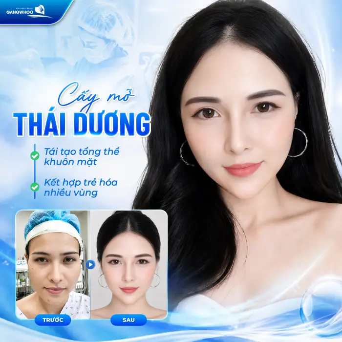 Cấy Mỡ Thái Dương Là Gì? Quy Trình, Hiệu Quả, Chi Phí 5 Cấy Mỡ Thái Dương Là Gì? Quy Trình, Hiệu Quả, Chi Phí