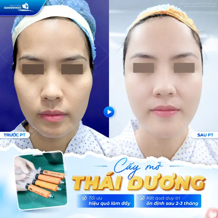 Cấy Mỡ Thái Dương Là Gì? Quy Trình, Hiệu Quả, Chi Phí 6 Cấy Mỡ Thái Dương Là Gì? Quy Trình, Hiệu Quả, Chi Phí