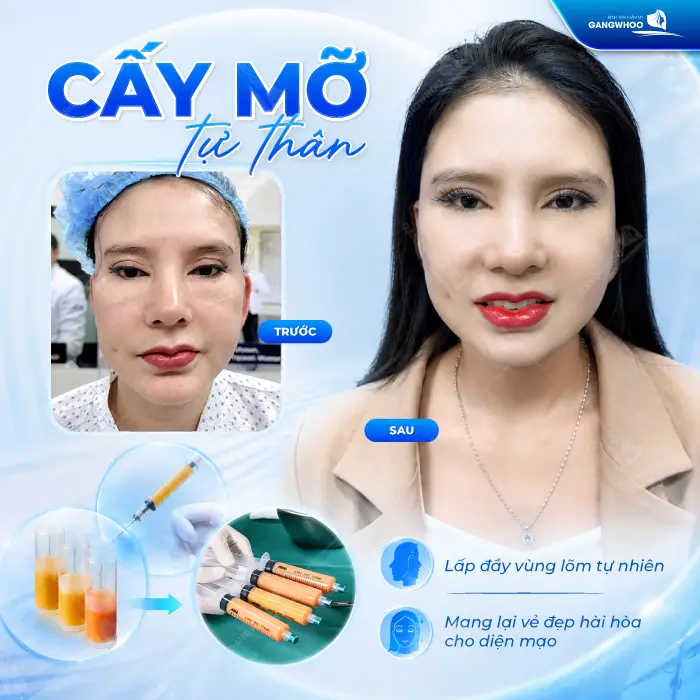 Cấy Mỡ Thái Dương Là Gì? Quy Trình, Hiệu Quả, Chi Phí 8 Cấy Mỡ Thái Dương Là Gì? Quy Trình, Hiệu Quả, Chi Phí