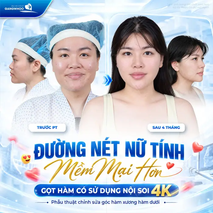 Gọt Hàm Có Để Lại Sẹo Không? Trường Hợp Có Nguy Cơ Bị Sẹo 1 Gọt hàm có sử dụng nội soi 4K đường nét gương mặt hài hòa, thêm mềm mại và nữ tính sau thực hiện