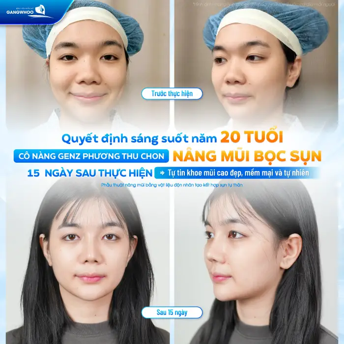 Từng Lỡ Nhiều Job Làm Mẫu Ảnh, GenZ 2K6 Quyết Định Nâng Mũi Để Không Bỡ Lỡ Cơ Hội