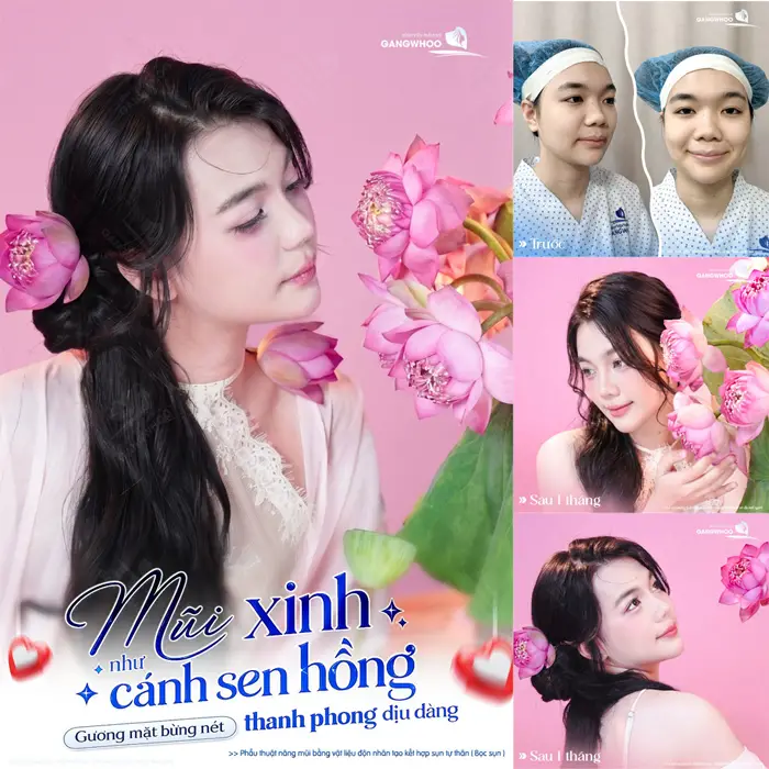 Mũi xinh mặt thêm bừng nét, diện mạo đẹp chuẩn cuốn hút và tràn đầy rạng rỡ