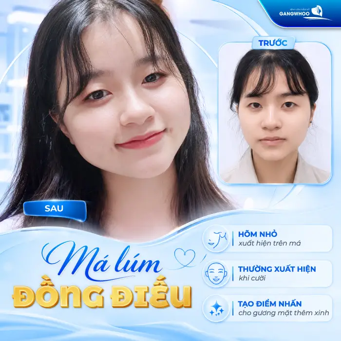 Má Lúm Đồng Điếu Là Gì? Ý Nghĩa, Cách Tạo Đẹp Tự Nhiên