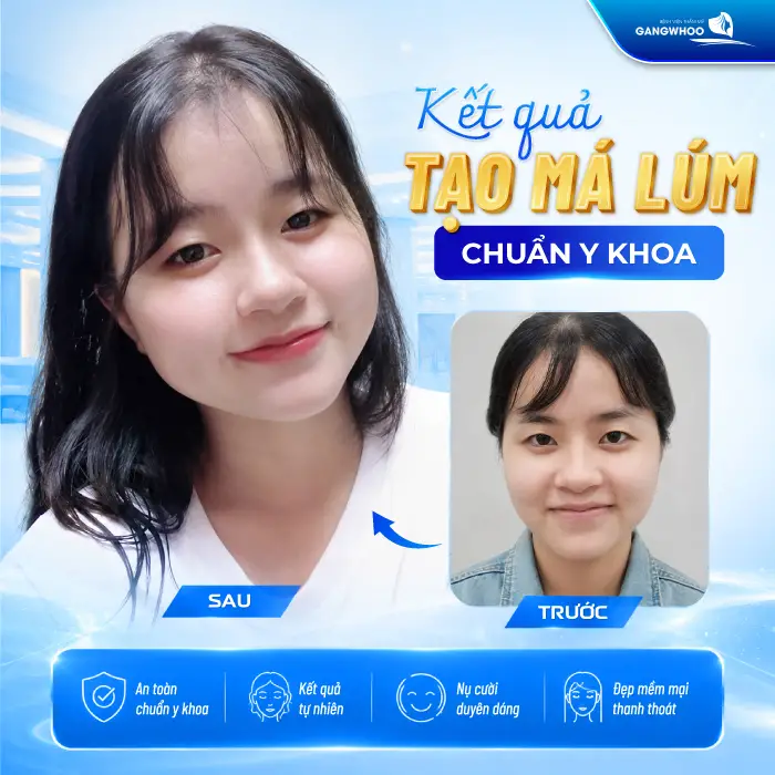 Má Lúm Đồng Điếu Là Gì? Ý Nghĩa, Cách Tạo Đẹp Tự Nhiên