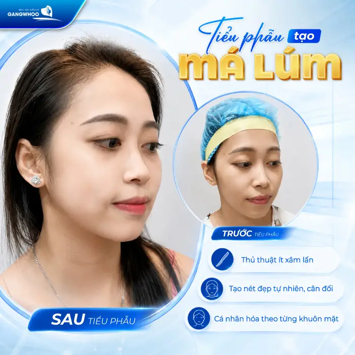 Má Lúm Đồng Điếu Là Gì? Ý Nghĩa, Cách Tạo Đẹp Tự Nhiên