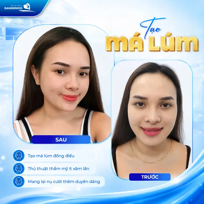 Má Lúm Đồng Điếu Là Gì? Ý Nghĩa, Cách Tạo Đẹp Tự Nhiên