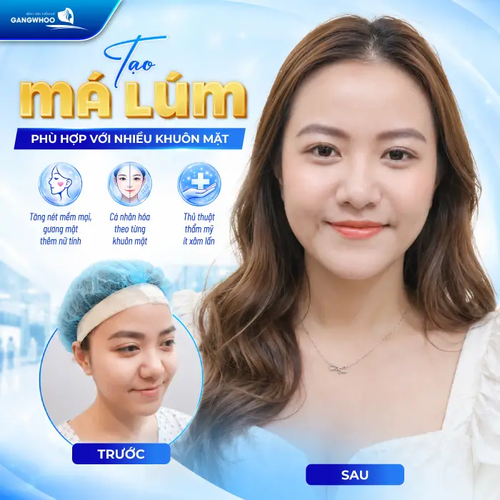 Má Lúm Đồng Điếu Là Gì? Ý Nghĩa, Cách Tạo Đẹp Tự Nhiên