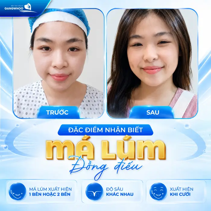 Má Lúm Đồng Điếu Là Gì? Ý Nghĩa, Cách Tạo Đẹp Tự Nhiên