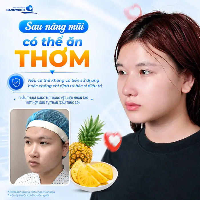 Nâng Mũi Ăn Thơm Được Không? Phải Kiêng Bao Lâu?