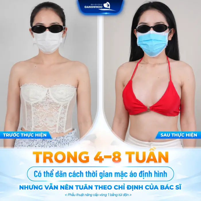 Nâng Ngực Bao Lâu Được Thả Rông? Bác Sĩ Giải Đáp Chi Tiết 4 Nâng Ngực Bao Lâu Được Thả Rông? Bác Sĩ Giải Đáp Chi Tiết