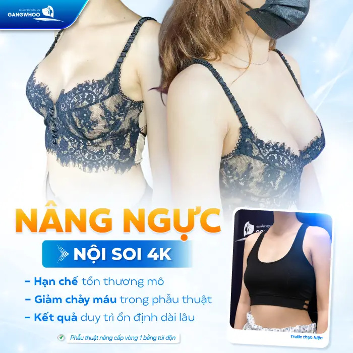 Nâng Ngực Bao Lâu Được Thả Rông? Bác Sĩ Giải Đáp Chi Tiết 5 Nâng Ngực Bao Lâu Được Thả Rông? Bác Sĩ Giải Đáp Chi Tiết