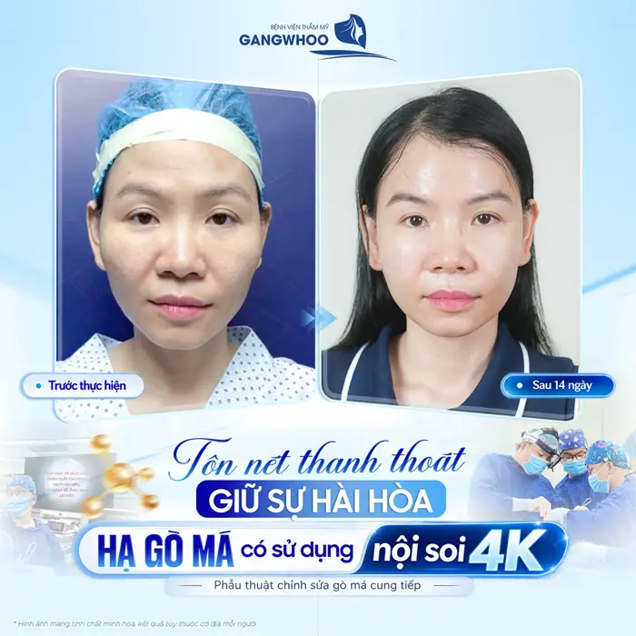 Tôn nét thanh thoát giữ sự hài hòa hạ gò má có sử dụng nội soi 4K 