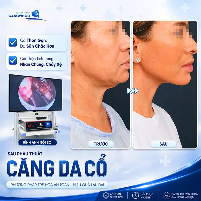 Căng Da Cổ Giá Bao Nhiêu? Bảng Giá Mới Năm 2026