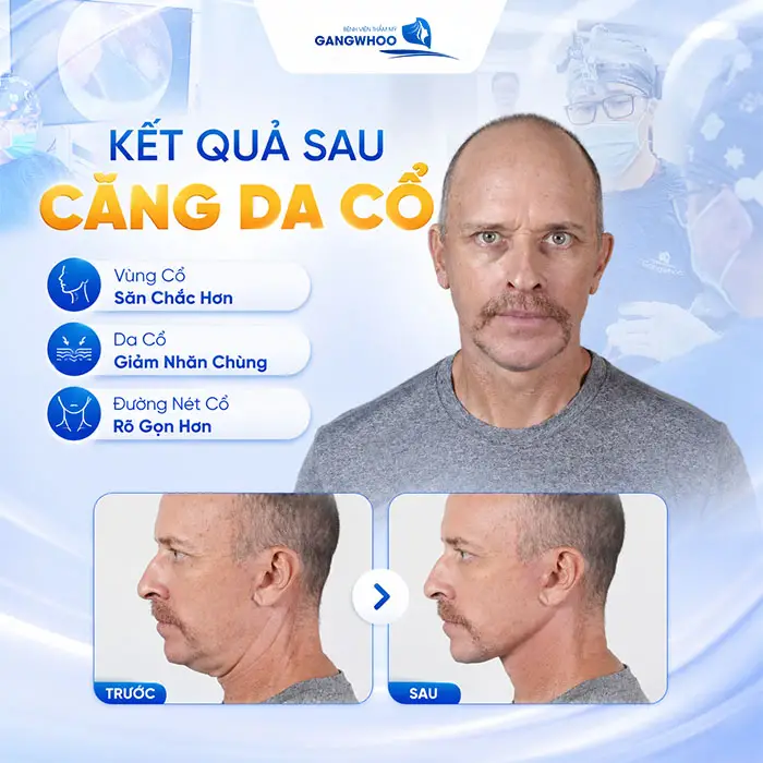 Căng Da Cổ Giá Bao Nhiêu? Bảng Giá Mới Năm 2026