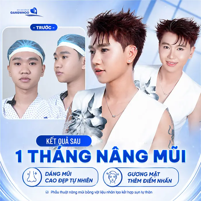 Kết quả sau 1 thágn nâng mũi dáng mũi cao đẹp tự nhiên giúp gương mặt thêm điểm nhấn